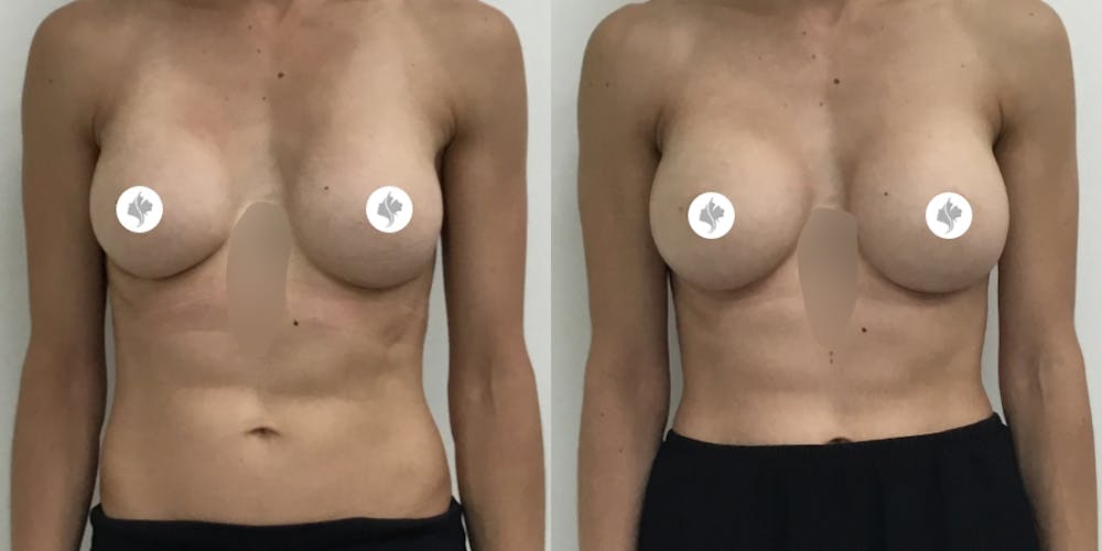 This is one of our beautiful breast implant revision patient #1