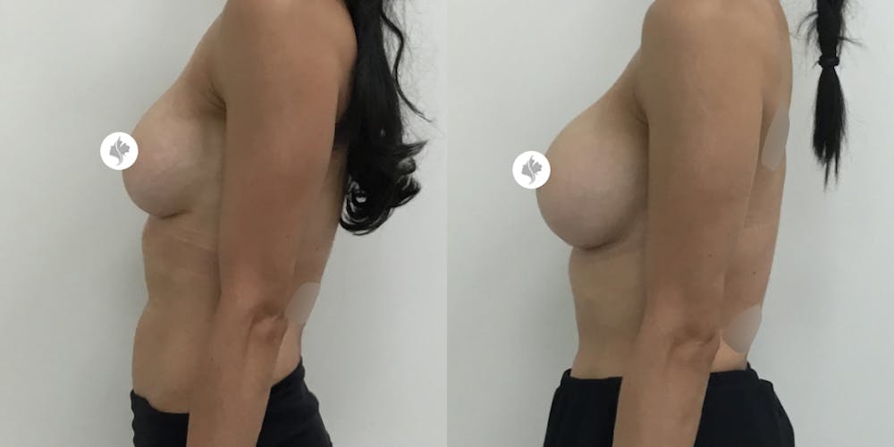 This is one of our beautiful breast implant revision patient #1