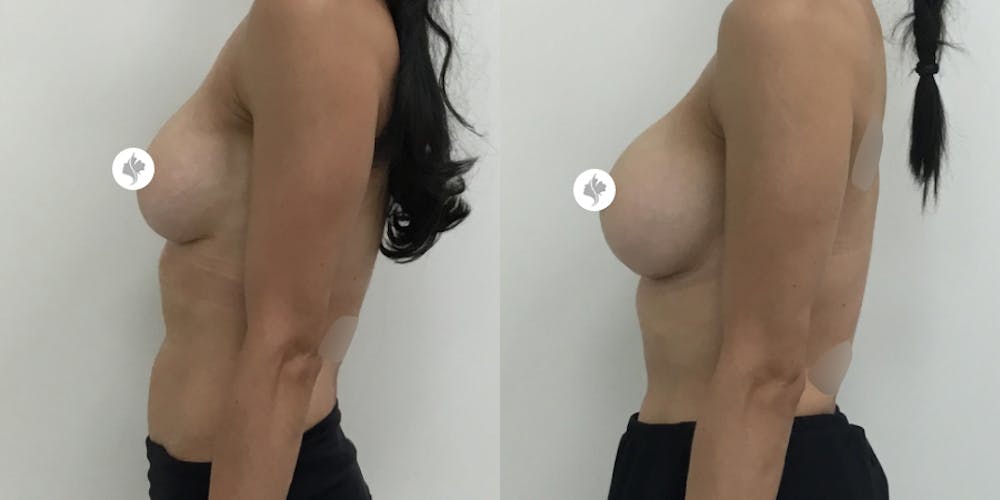 This is one of our beautiful breast augmentation patient #2