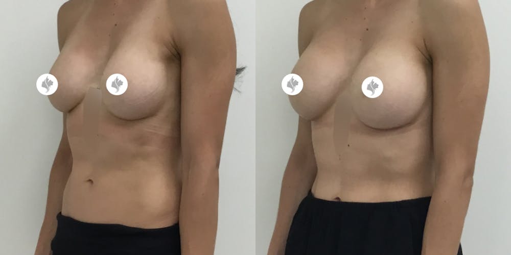 This is one of our beautiful breast implant revision patient #1