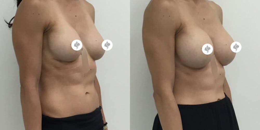 This is one of our beautiful breast augmentation patient #2