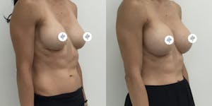 This is one of our beautiful breast implant revision patient 1