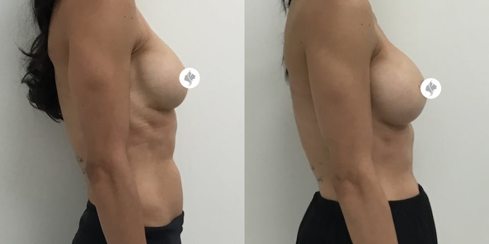 This is one of our beautiful breast implant revision patient #1