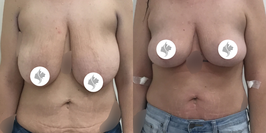 This is one of our beautiful breast reduction patient 69