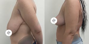 This is one of our beautiful breast reduction patient 69