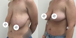 This is one of our beautiful breast reduction patient 69
