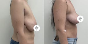 This is one of our beautiful breast reduction patient 69
