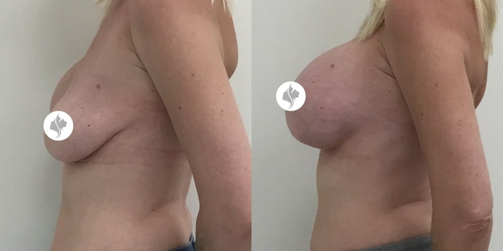 This is one of our beautiful breast augmentation patient #20