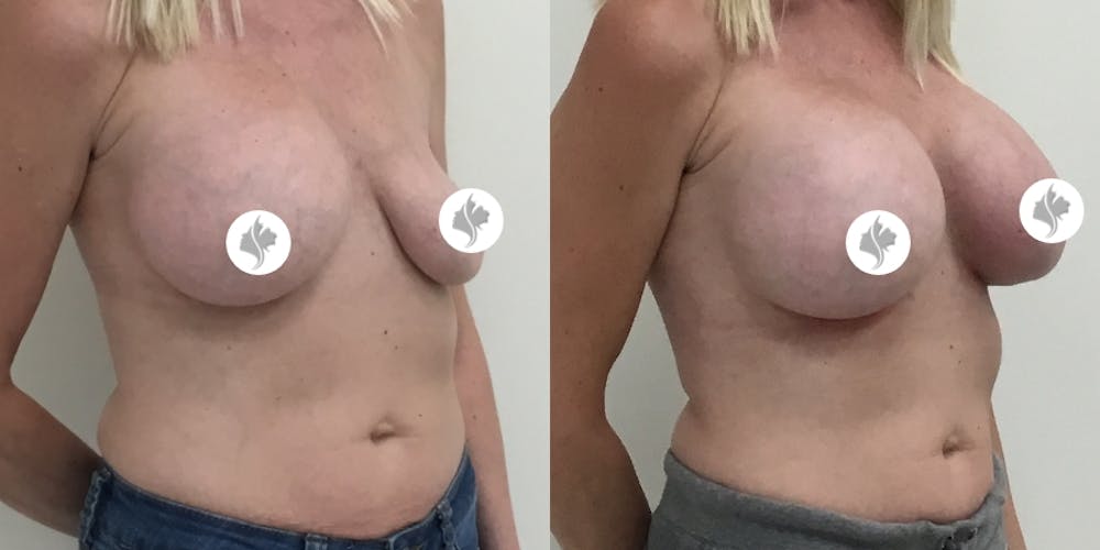 This is one of our beautiful breast augmentation patient #20