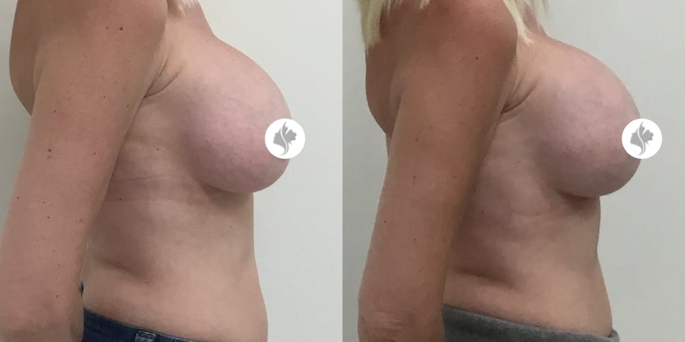 This is one of our beautiful breast augmentation patient #20