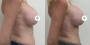 This is one of our beautiful breast augmentation patient 20