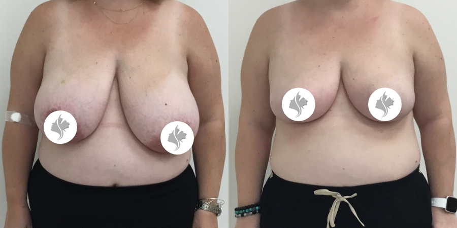 This is one of our beautiful breast asymmetry correction patient 6