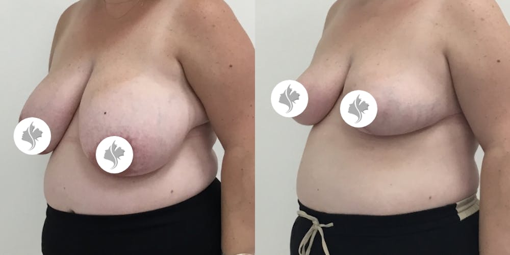 This is one of our beautiful breast asymmetry correction patient #6