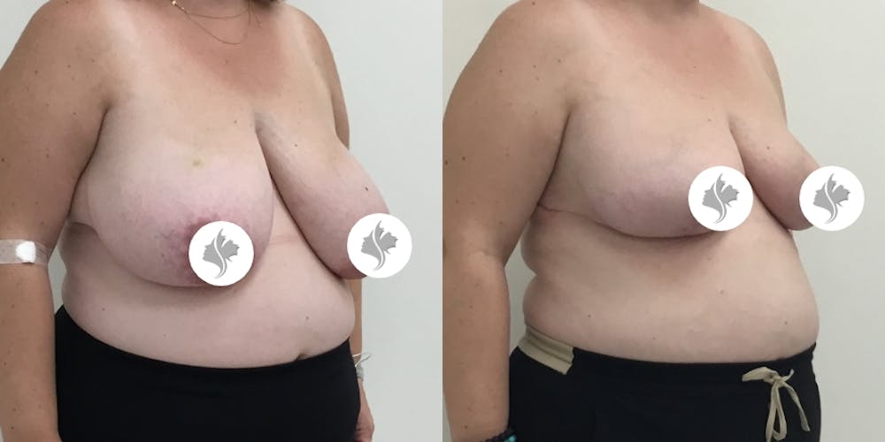 This is one of our beautiful breast asymmetry correction patient #6