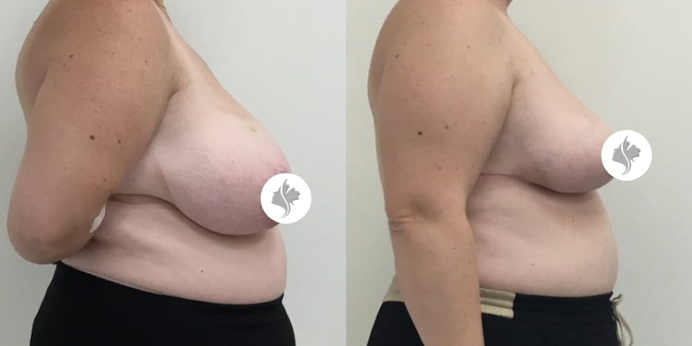 This is one of our beautiful breast asymmetry correction patient #6