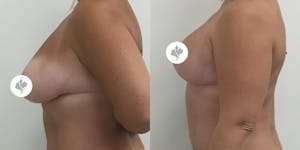 This is one of our beautiful breast reduction patient 8