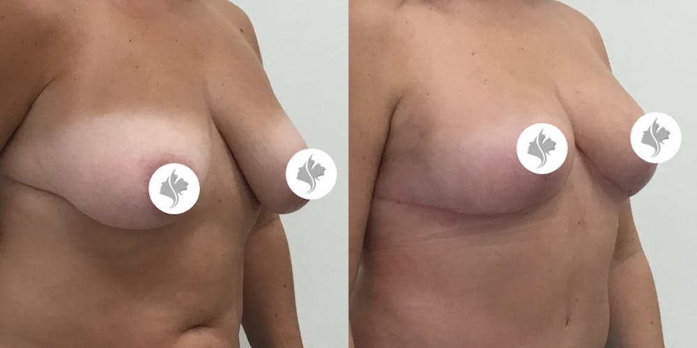 This is one of our beautiful breast reduction patient #8