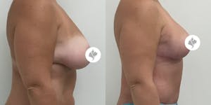 This is one of our beautiful breast reduction patient 8