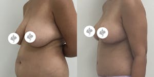 This is one of our beautiful breast reduction patient 70