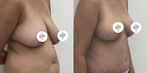 This is one of our beautiful breast reduction patient 70