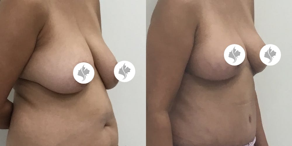 This is one of our beautiful breast reduction patient #70