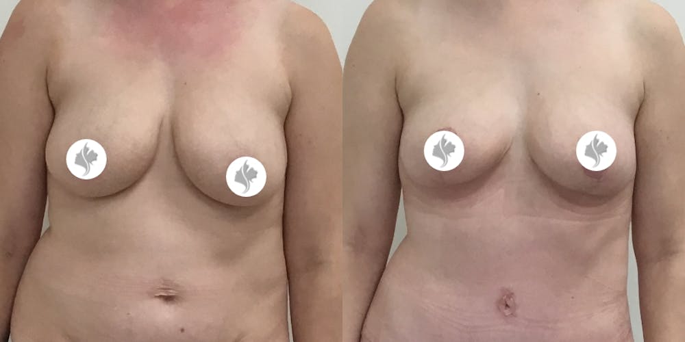 This is one of our beautiful breast asymmetry correction patient #10