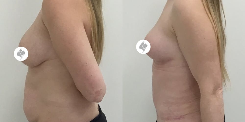 This is one of our beautiful breast asymmetry correction patient #10