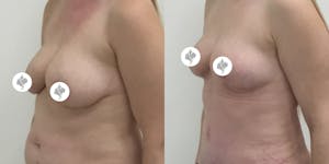 This is one of our beautiful breast asymmetry correction patient 10
