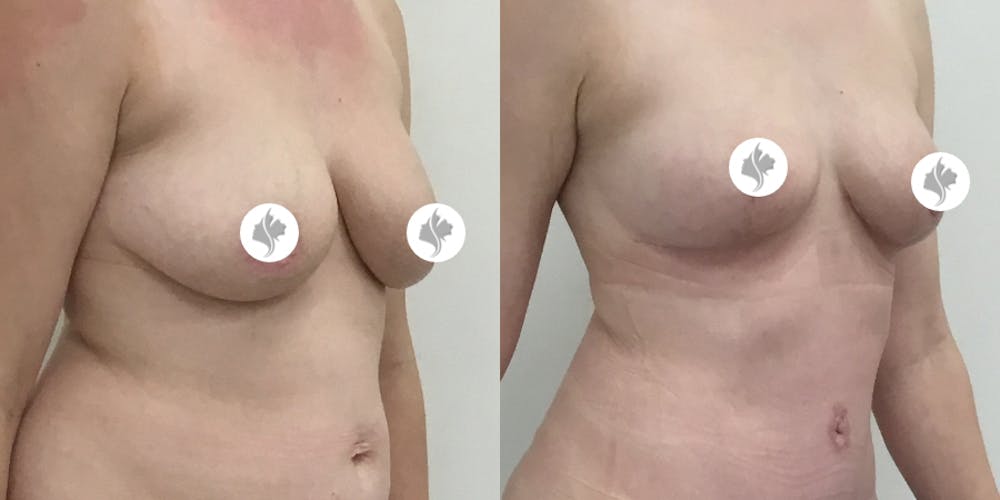 This is one of our beautiful breast asymmetry correction patient #10