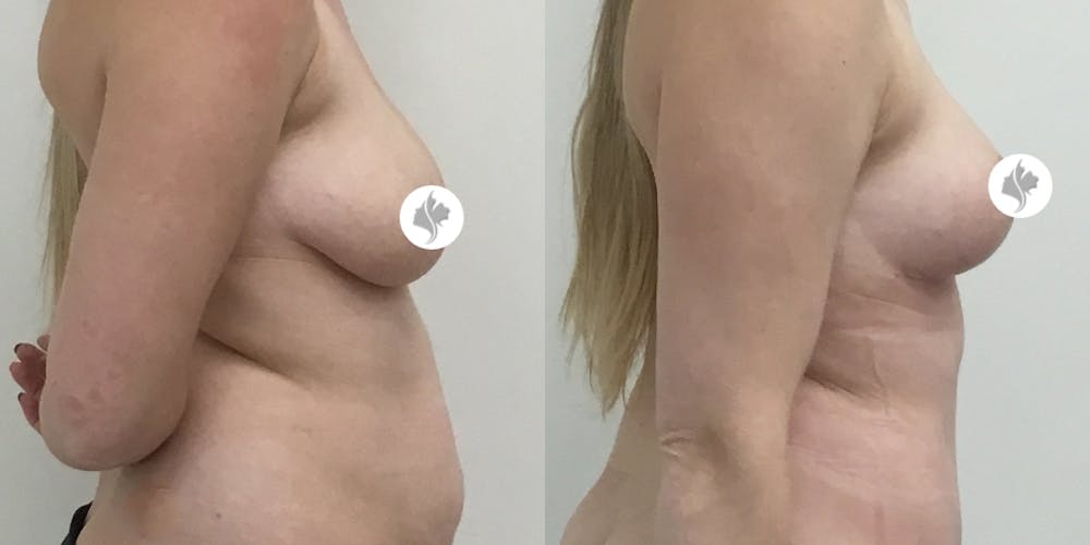 This is one of our beautiful breast asymmetry correction patient #10