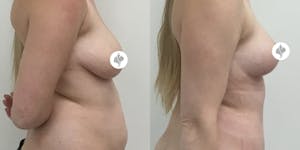 This is one of our beautiful breast asymmetry correction patient 10