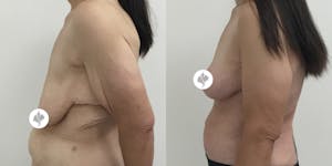 This is one of our beautiful breast reduction patient 9
