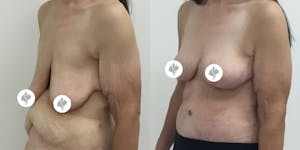 This is one of our beautiful breast reduction patient 9