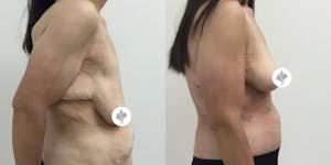 This is one of our beautiful breast reduction patient 9