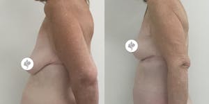 This is one of our beautiful breast reduction patient 72