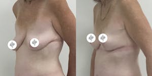 This is one of our beautiful breast reduction patient 72