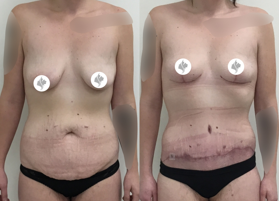 This is one of our beautiful tummy tuck patient 56