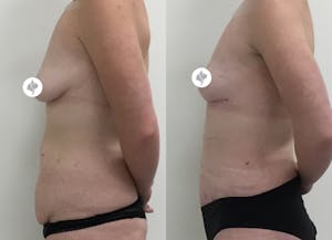 This is one of our beautiful tummy tuck patient 56