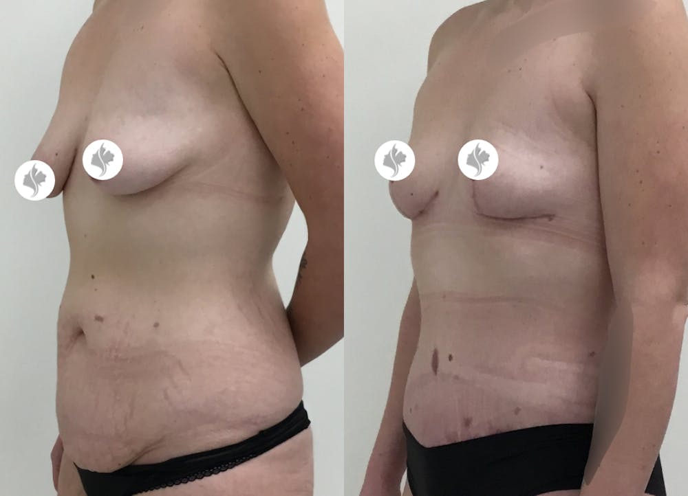 This is one of our beautiful tummy tuck patient #60