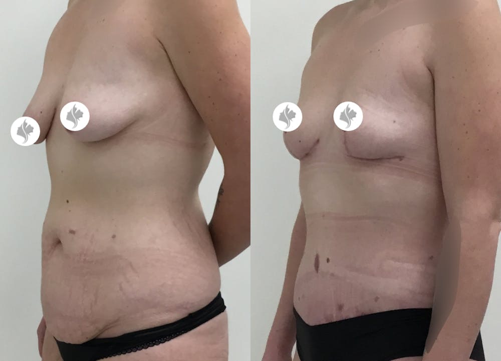 This is one of our beautiful tummy tuck patient #56