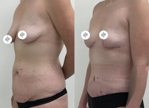 This is one of our beautiful tummy tuck patient 56