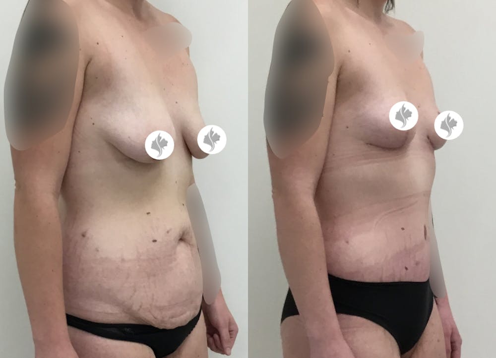 This is one of our beautiful tummy tuck patient #56