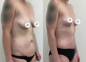 This is one of our beautiful tummy tuck patient 56