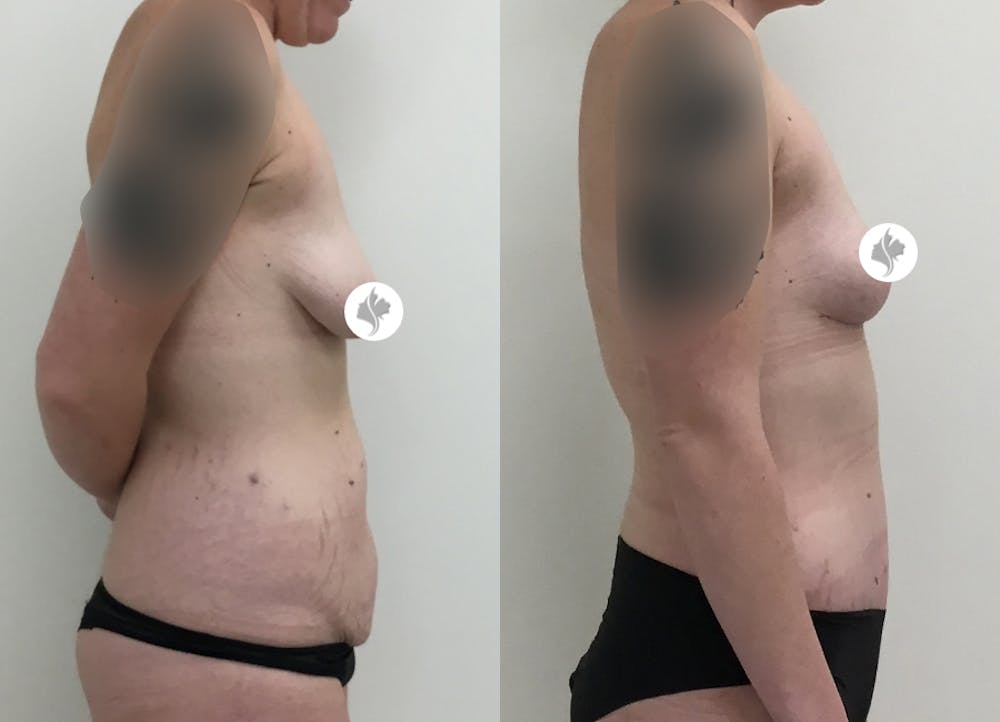 This is one of our beautiful tummy tuck patient #56