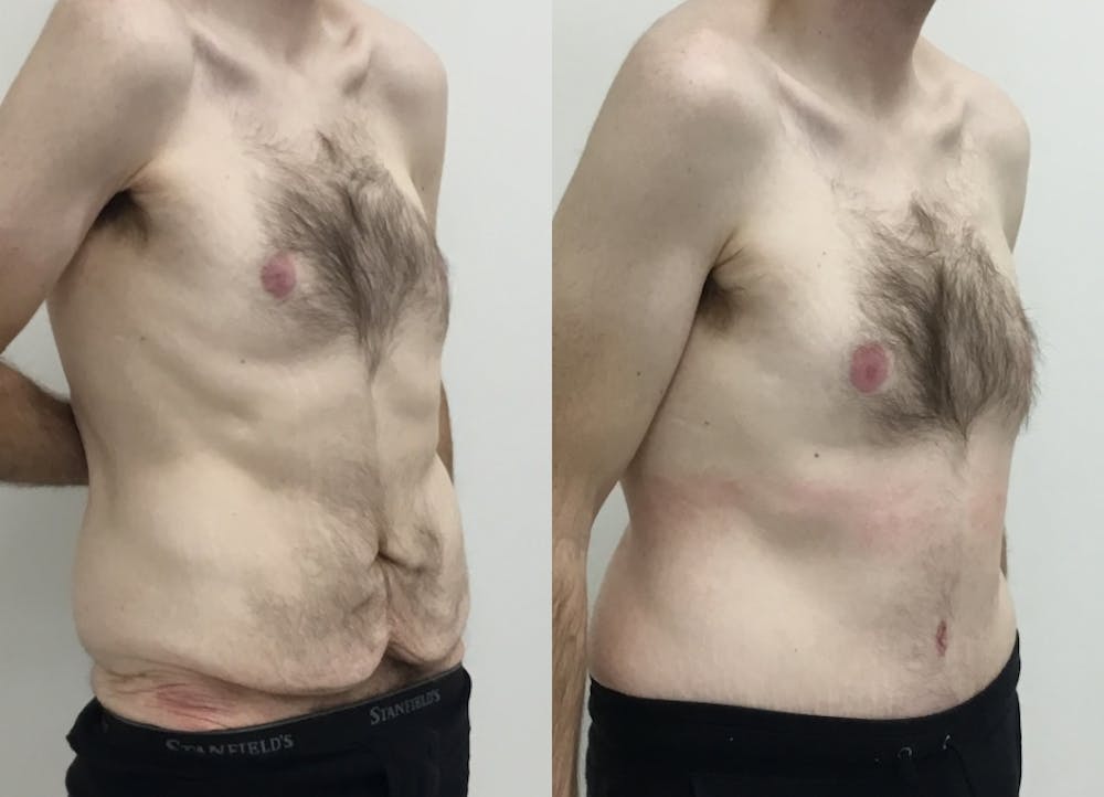This is one of our beautiful tummy tuck patient #61