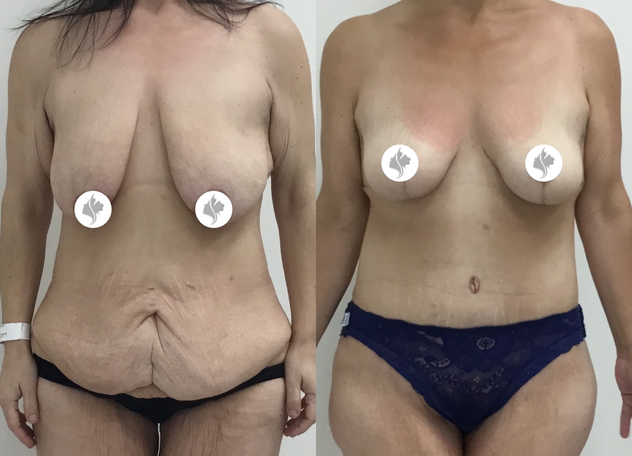 This is one of our beautiful post-bariatric body contouring patient 34