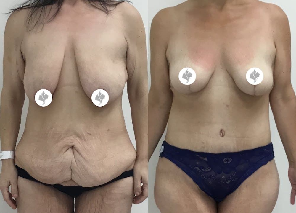 This is one of our beautiful post-bariatric body contouring patient #34