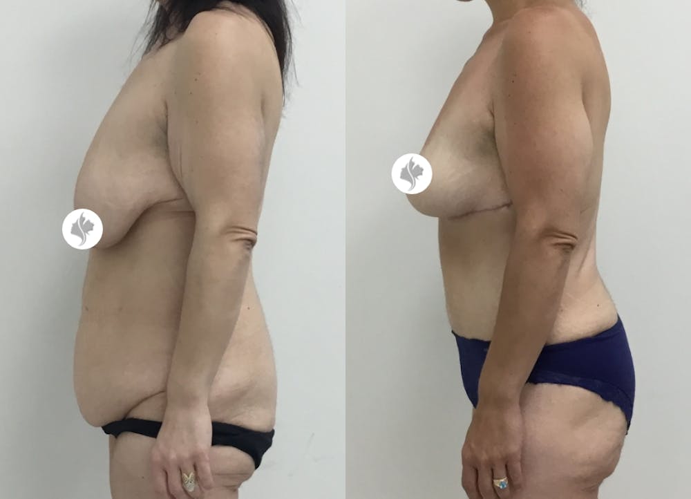 This is one of our beautiful post-bariatric body contouring patient #34