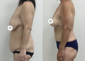 This is one of our beautiful patient 58 patient 58