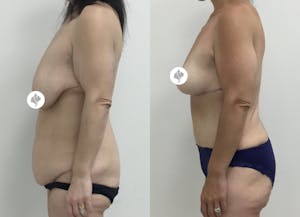This is one of our beautiful post-bariatric body contouring patient 34